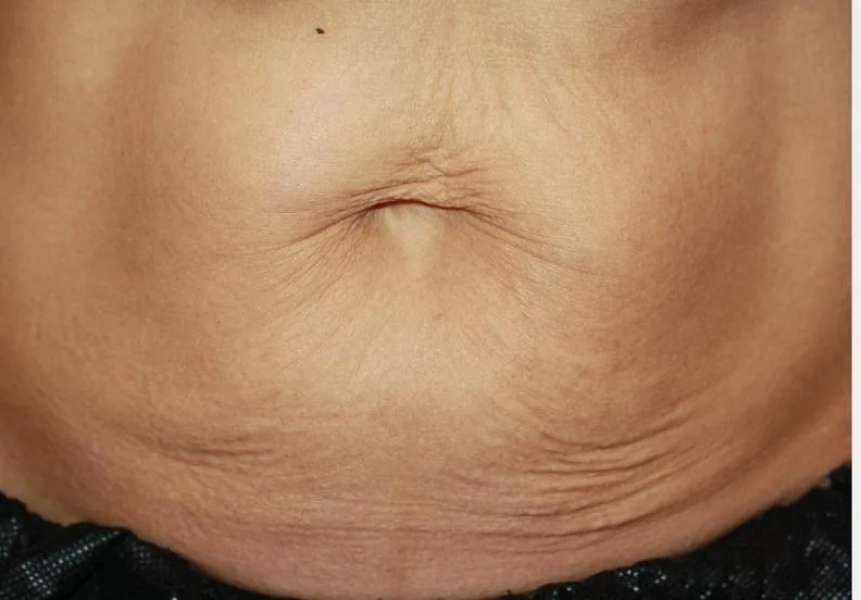 Abdomen: antes