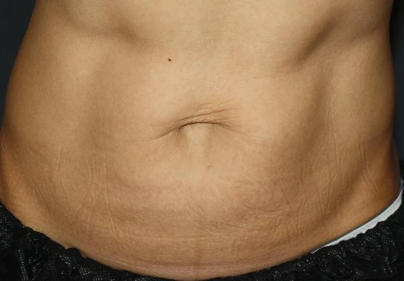 Abdomen con la piel más firme
