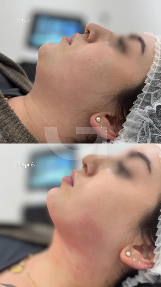 Cuello y línea de la mandíbula antes y después del endolifting
