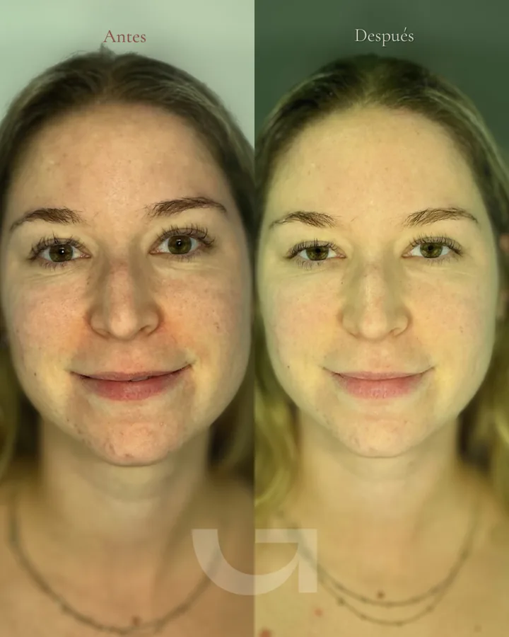 Rostro antes y después de la luz pulsada