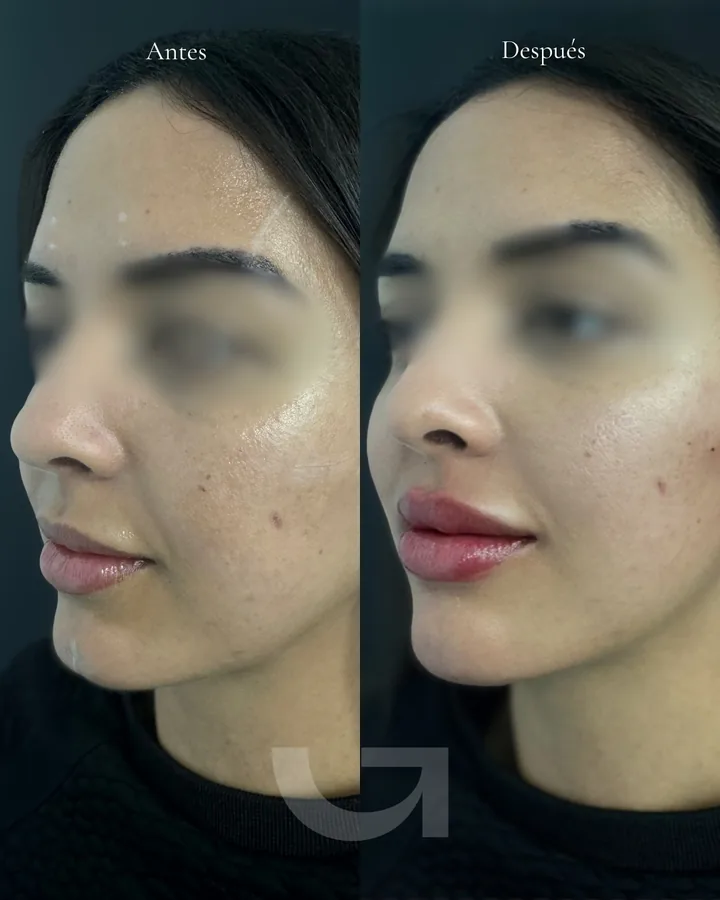 Labios antes y después del tratamiento