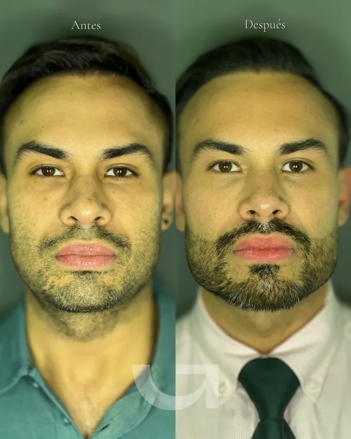 Rostro masculino antes y después de definir la mandíbula