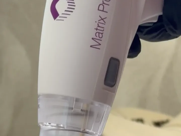 Pieza de mano Matrix Pro de Candela durante un tratamiento