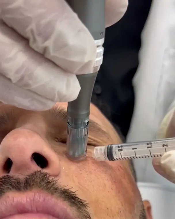 Microneedling en la mejilla durante una sesión