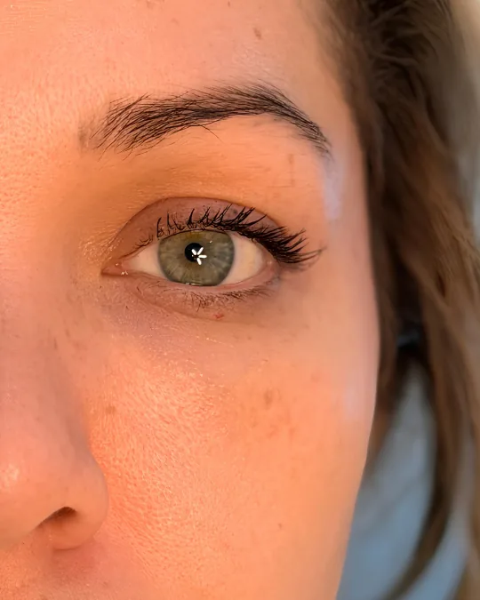 Contorno de ojos tras un tratamiento de ojeras