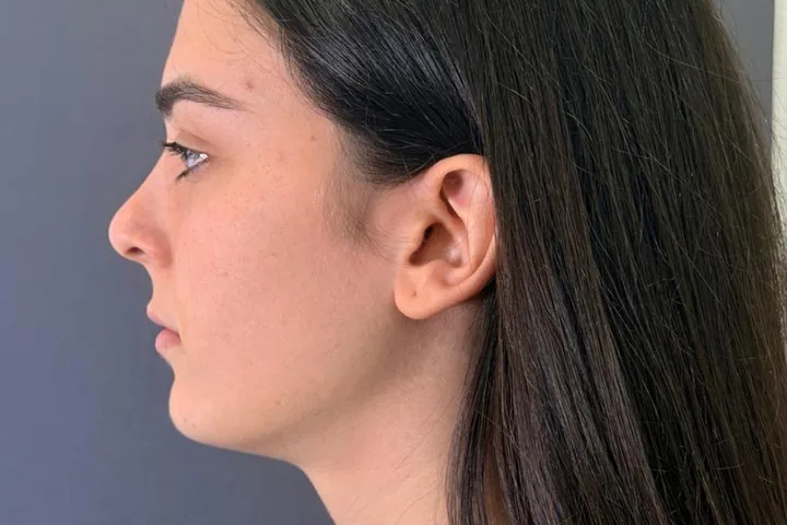 Perfil facial antes de la armonización