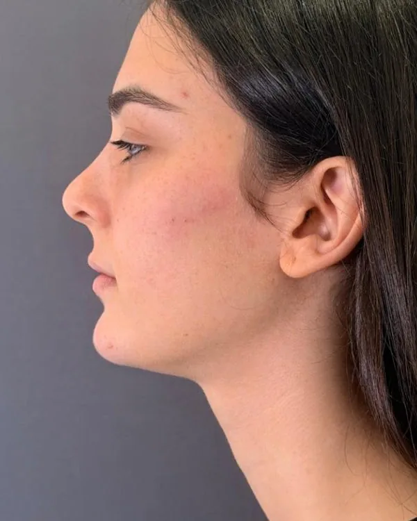 Perfil facial tras una armonización con ácido hialurónico