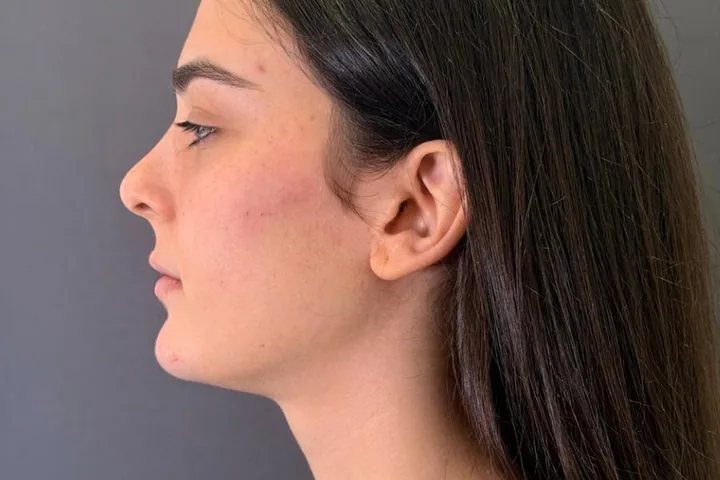Perfil facial después de la armonización