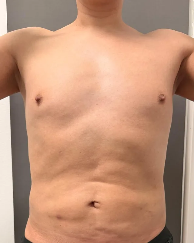 Abdomen y flancos con grasa localizada