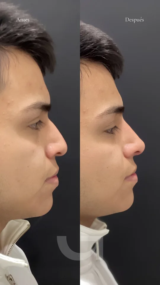Perfil de la nariz antes y después de una rinomodelación