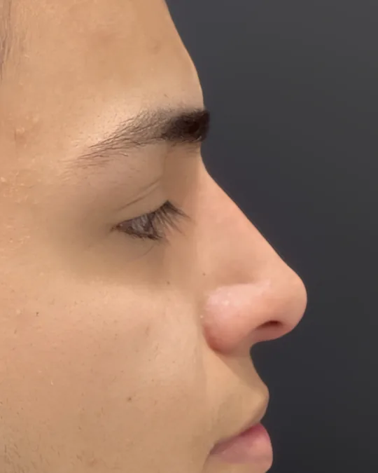 Perfil de la nariz tras una rinomodelación